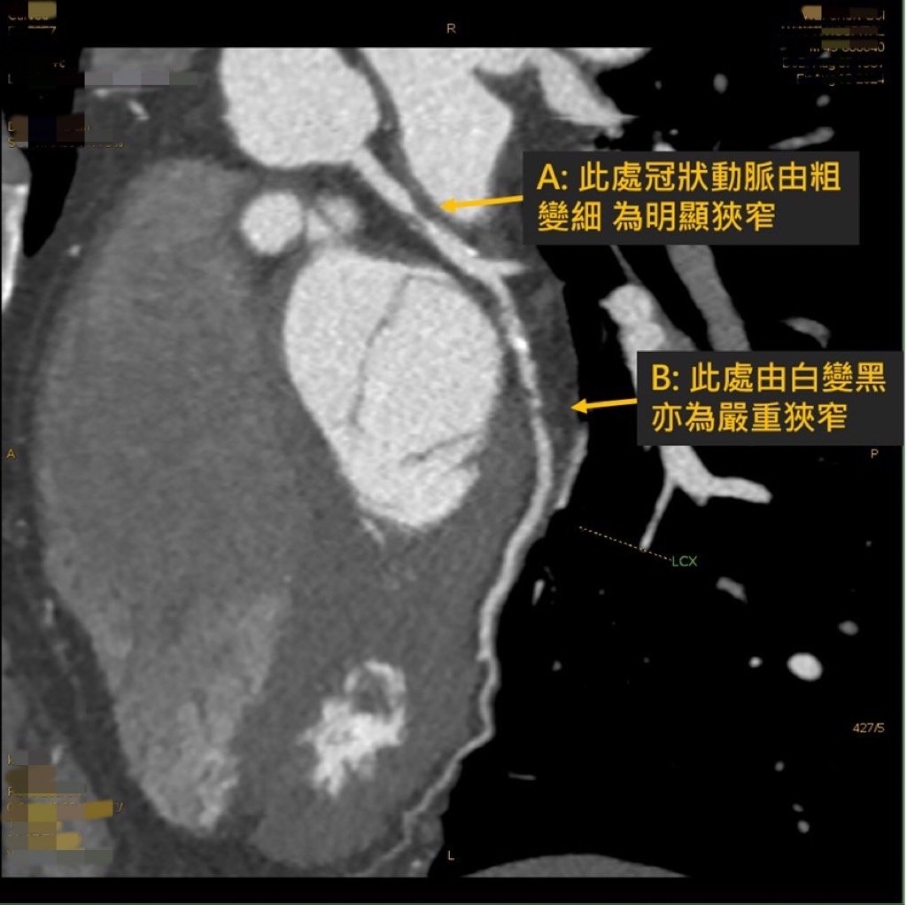 心肌梗塞有徵兆？安南醫院推這項無痛掃描能提早發現心臟危機