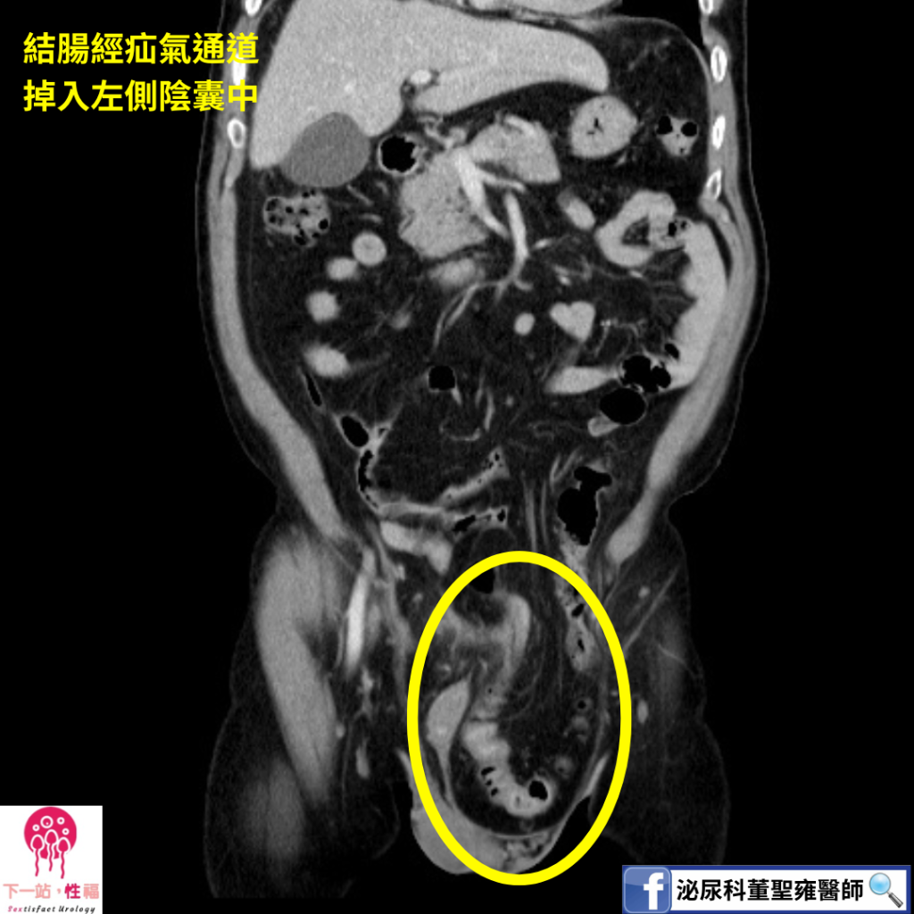70歲翁雙側腹股溝疝氣纏身 臺南市立安南醫院達文西機器人手術一次到位修補重拾行動力