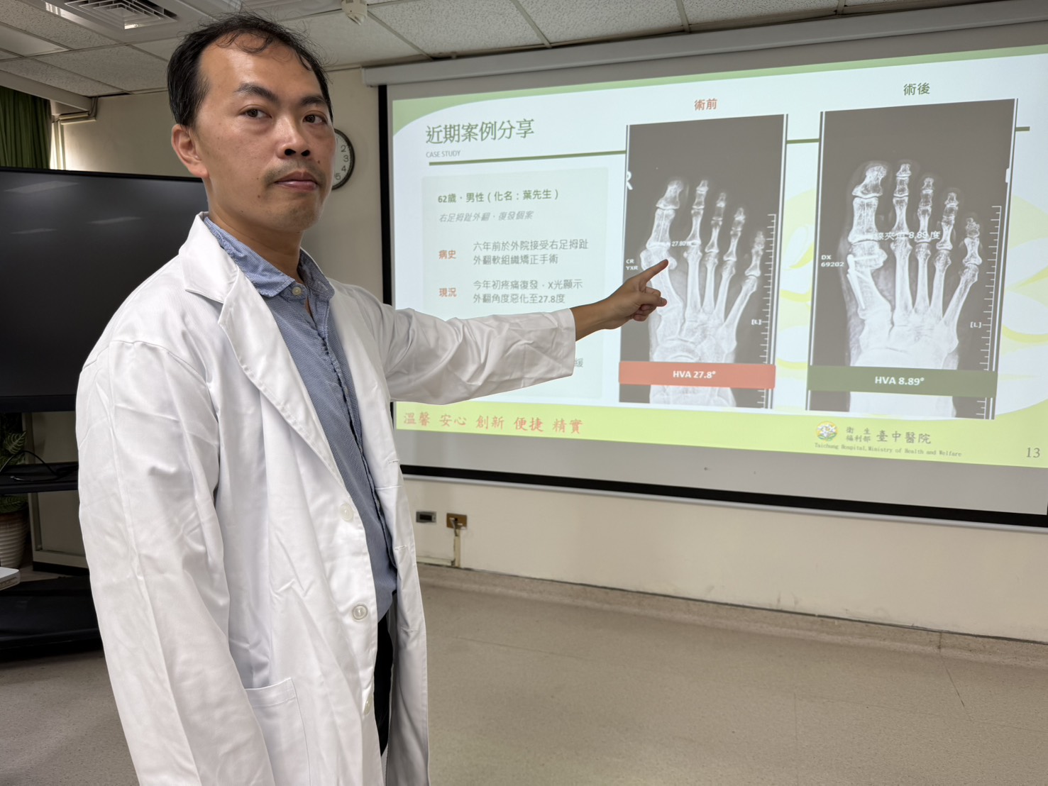 衛生福利部臺中醫院骨科周育名醫師說明患者到院時，右腳拇指外翻28度（左圖），疼痛難耐，經過截骨矯正手術後（右圖）恢復良好，已經可以恢復最愛的登山健行活動。