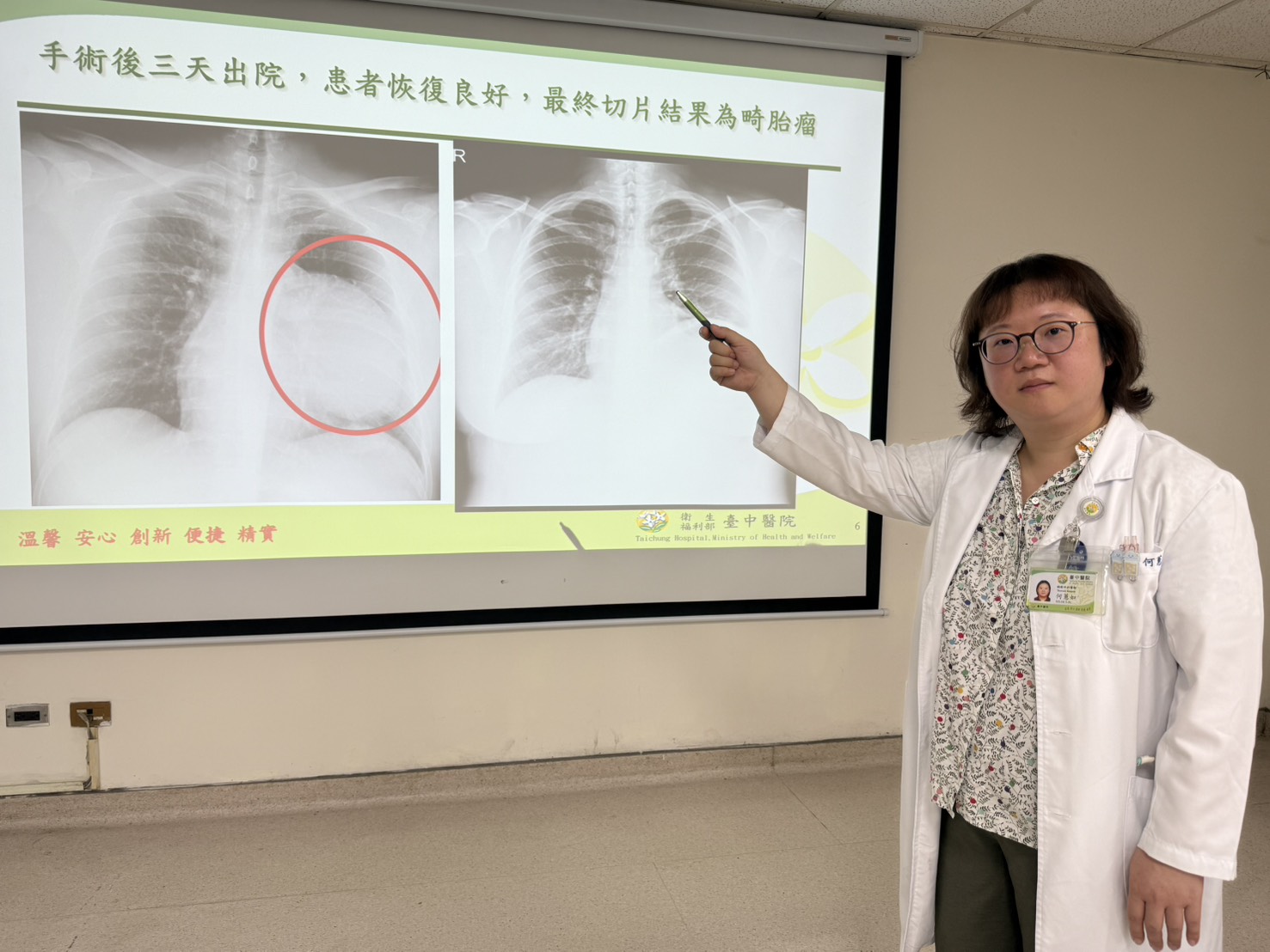 社會新鮮人求職健檢驚見15公分巨大腫瘤　胸腔鏡手術發現竟是畸胎瘤