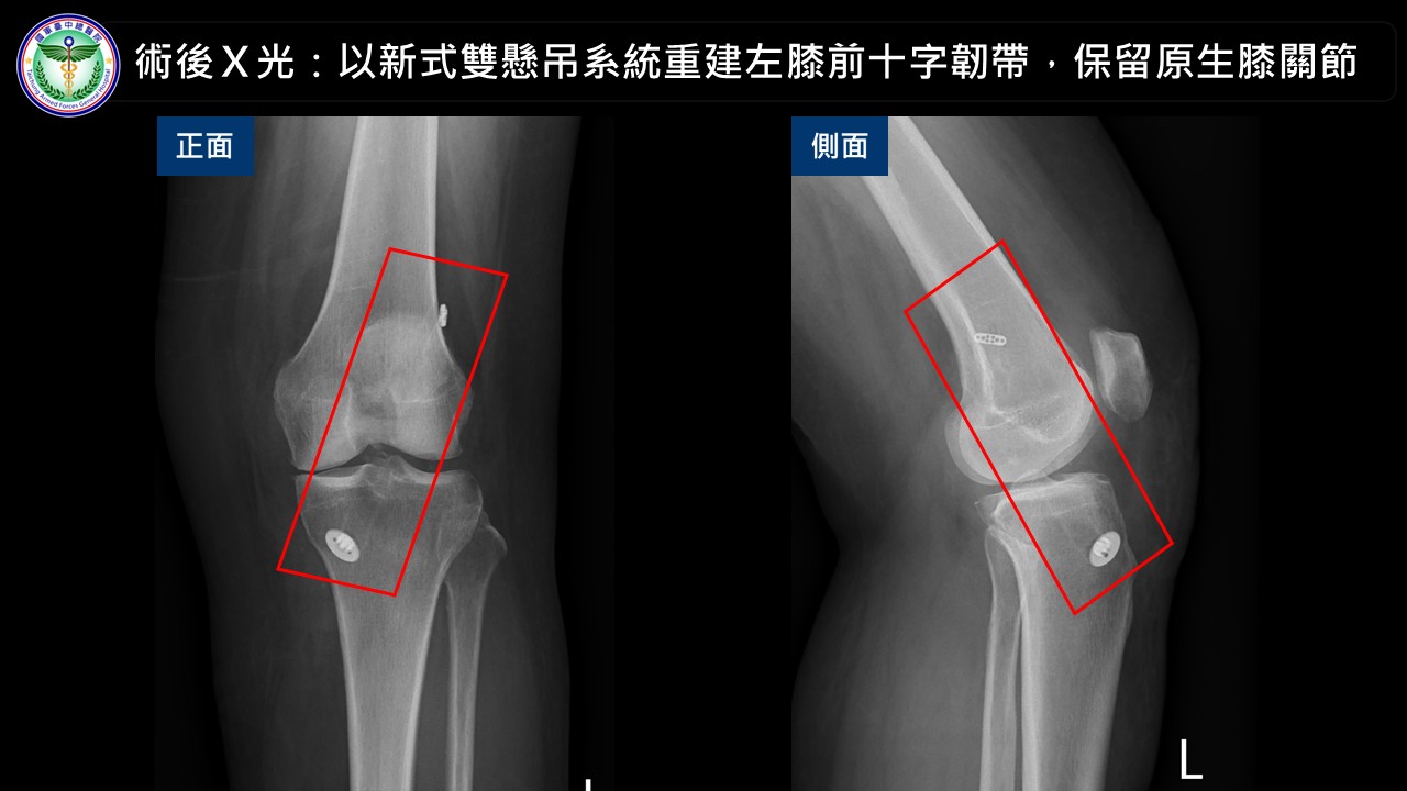 55歲婦膝蓋反覆軟腳竟是韌帶斷裂！台中醫院新式手術助保住原生膝關節