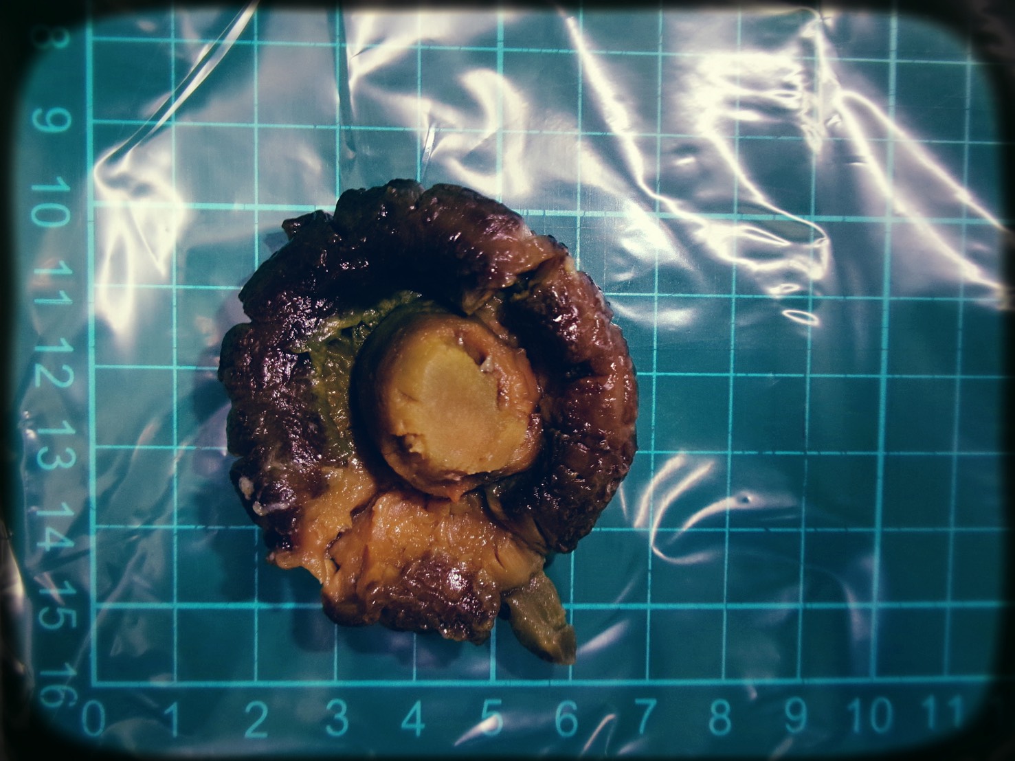 六旬男突發腹痛竟是腸阻塞！醫師開刀取出「整朵香菇」揭原因