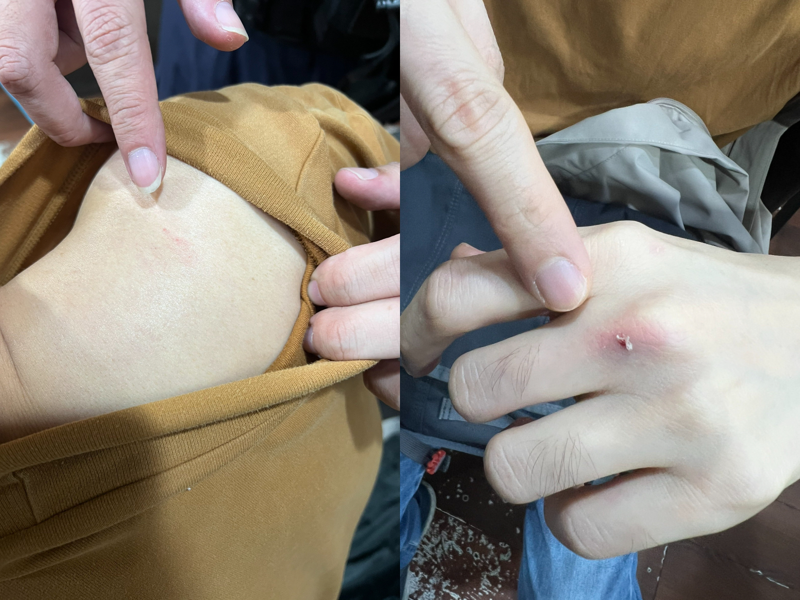 遭攻擊的陳男因躲避不及，導致肩膀及手臂嚴重瘀青，手指關節處亦有多處擦傷。