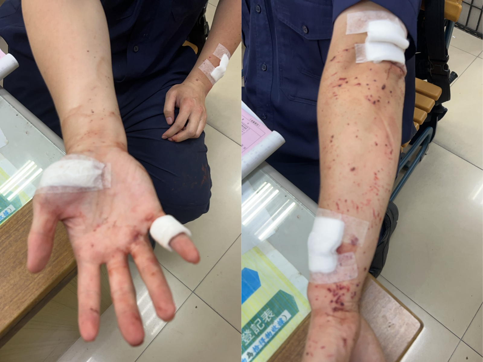 員警隨後被緊急送往林口長庚醫院治療,經診斷手部受有嚴重裂傷,共縫合4針,所幸治療後無生命危險。