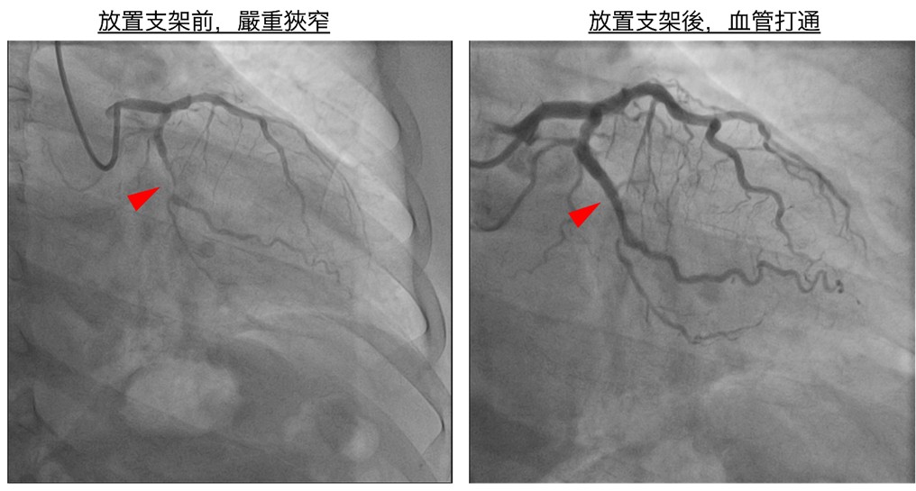 臺中市立老人復健綜合醫院(簡稱臺中市立醫院)心血管中心團隊醫師:心臟內科主任簡思齊(左)、心臟內科暨導管室主任鍾偉信(右)與患者合影。