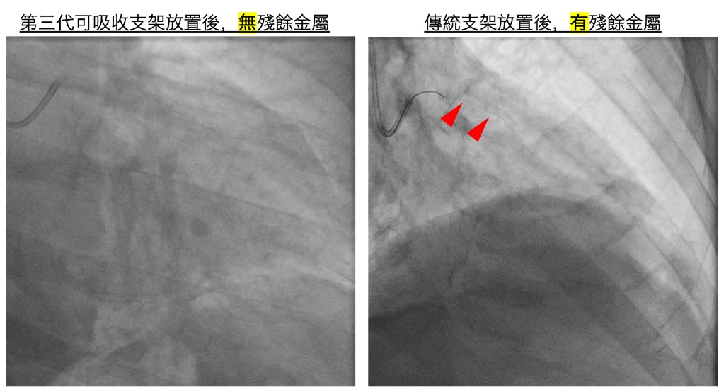 放置第三代可吸收支架,一年內約99%會被身體吸收,不會殘留異物或造成長期發炎。(非患者本人)