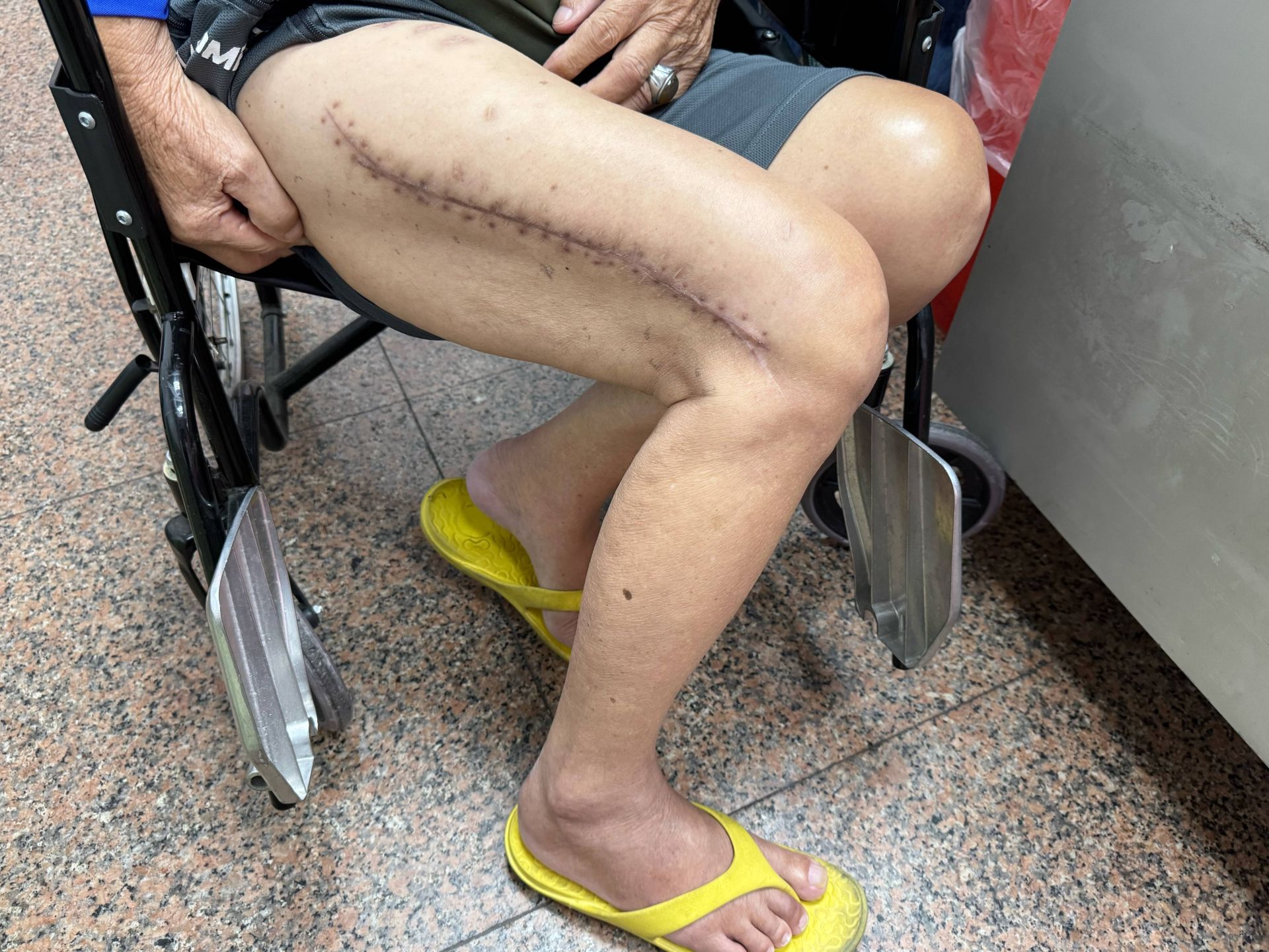 8旬翁大腿斷三截 三次術後喊「我要再參加媽祖遶境」