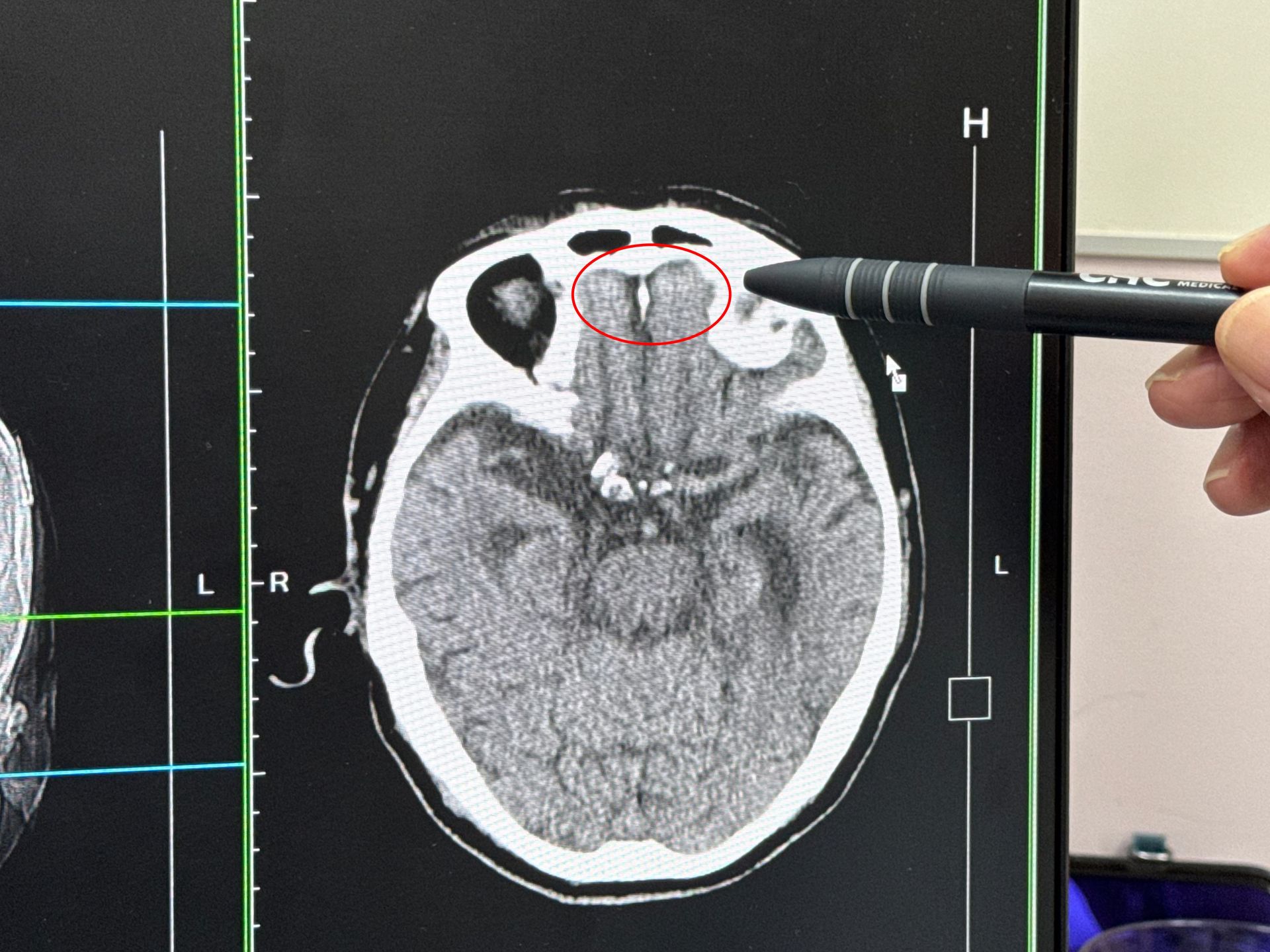 9旬翁牽機車跌倒頭撕裂腦出血 醫籲注意居家安全