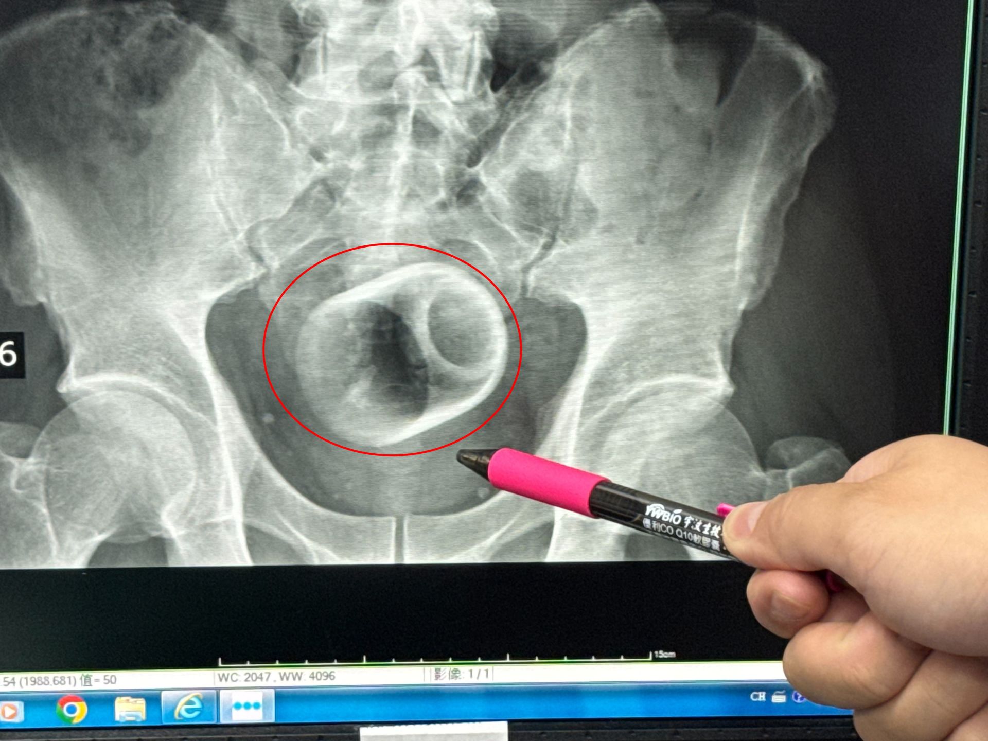 瓷杯爆菊花! 男3天無法解便 醫開刀急取出