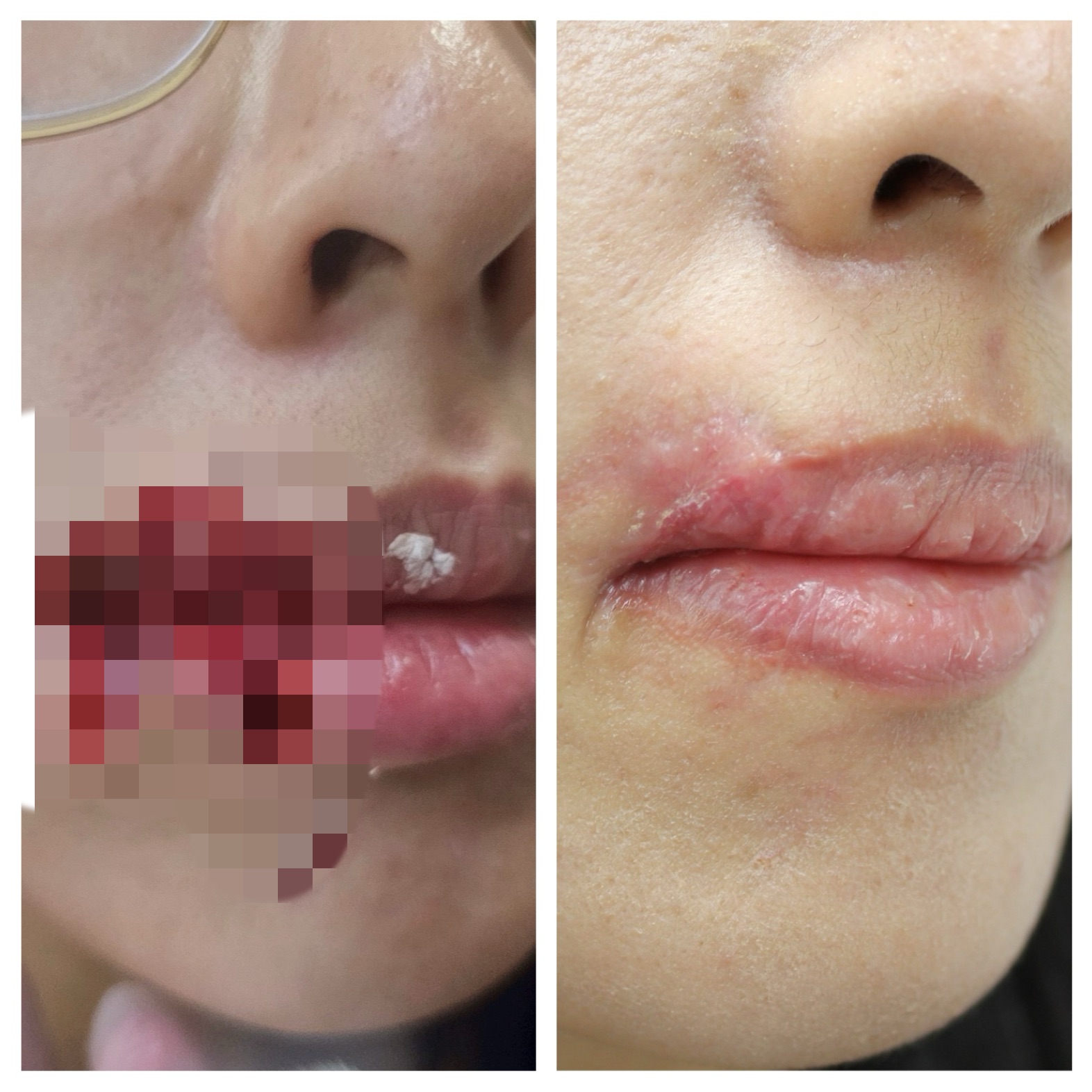 台中28歲妙齡女被愛犬咬掉嘴邊肉！ 　黃金6小時PRP增生療法修復成功