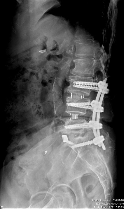 【手術前及手術後】手術前有脊椎滑脫不穩定及脊椎狹窄造成神經壓迫(左圖)。手術後除了重建椎間高度，也將腰椎的生理曲線重建為較理想的前凸狀態(右圖)。