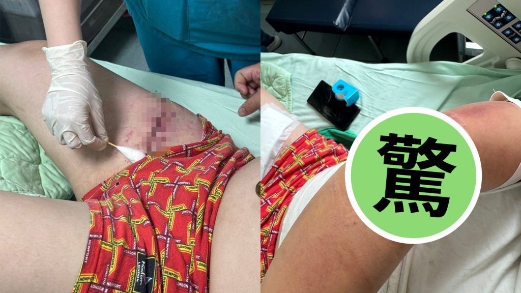 獨／台南仁德服務區驚傳砍人！男下車抽菸慘遭追砍　大腿12公分刀傷曝光
