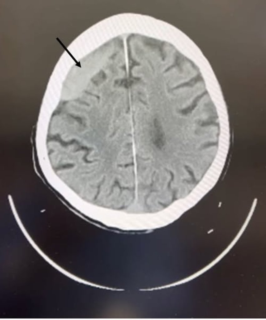 老人跌倒腦出血緊急手術救回一命 醫師呼籲注意頭部外傷