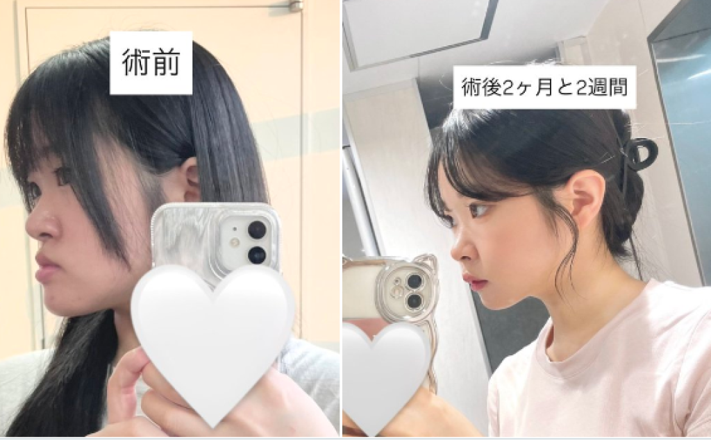 櫻花妹顎骨異常！自PO手術前後對比照「親和力加三成」　網友驚呆：太可愛了