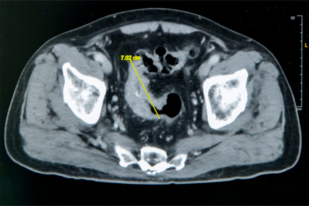 雲林七旬翁便秘 竟是7公分大腸癌惹禍