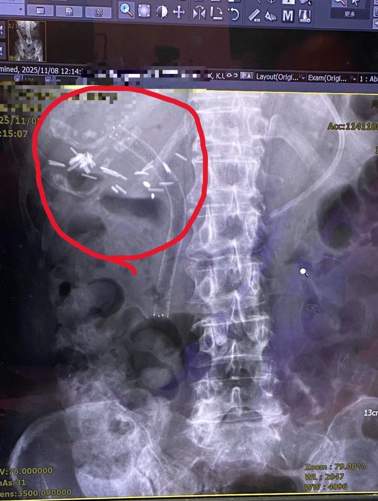 罹癌婦人膽道塑膠支架阻塞 發燒、噁心 置換金屬支架後脫離險境