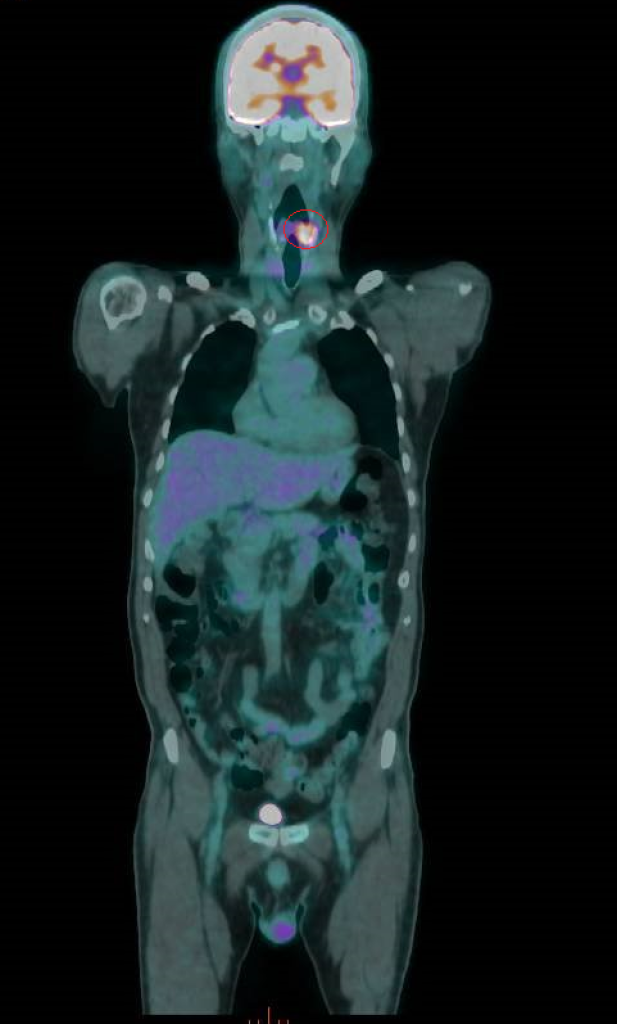 菸檳酒惹的禍 56歲男下咽癌復發「切全喉」求生