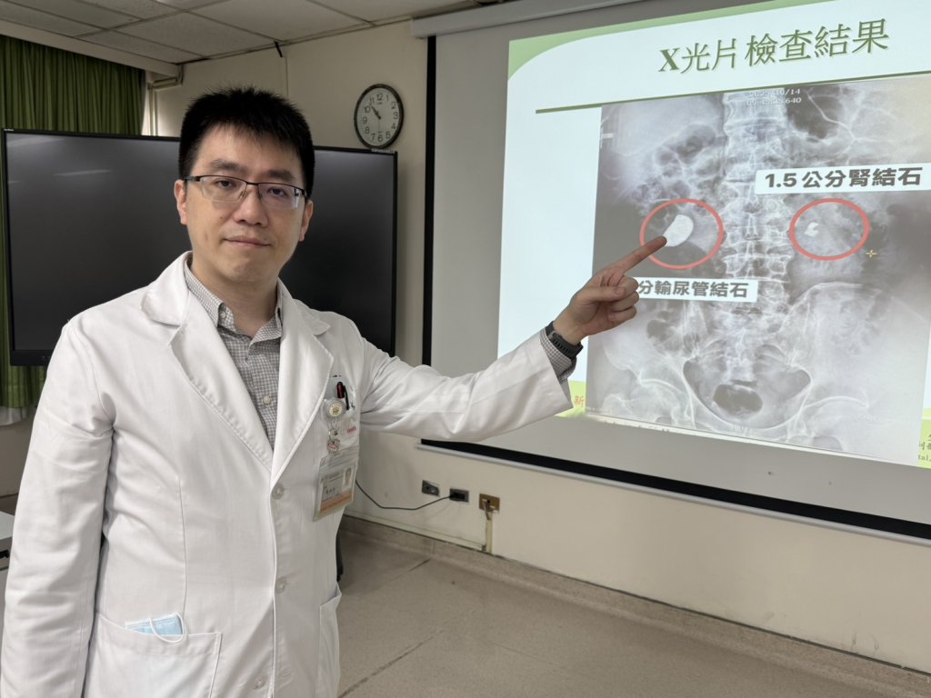 他腰痠血尿就醫 驚！右輸尿與左腎赫見大結石