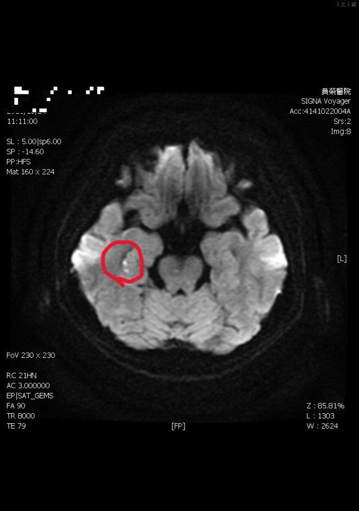 女子反覆問同樣問題，事後完全不記得 罹患了隱形中風「短暫性全面失憶症」
