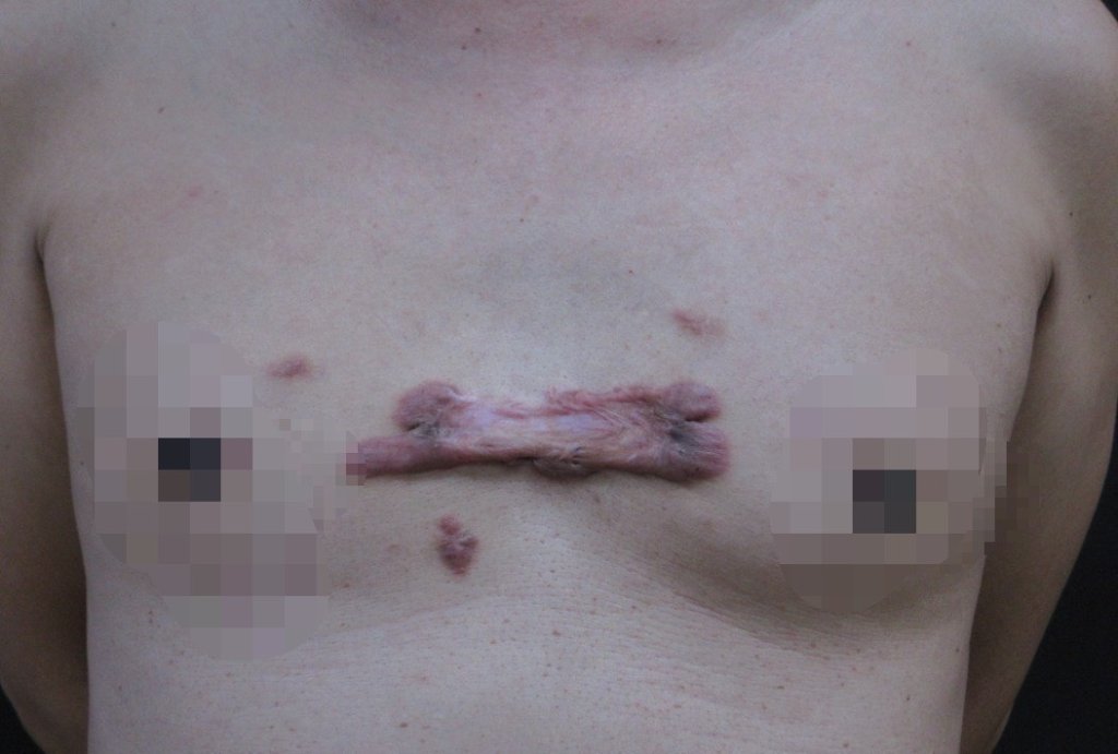 青春痘捏破異常增生成「蟹足腫」 整形外科以羊膜生長因子治療改善