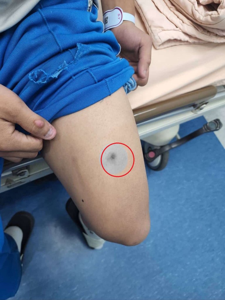  獨家爆料／ 雙腿遭射出2個洞！ 弟弟遭同學拿BB槍射擊影片曝光　姊：槍孔實在明顯