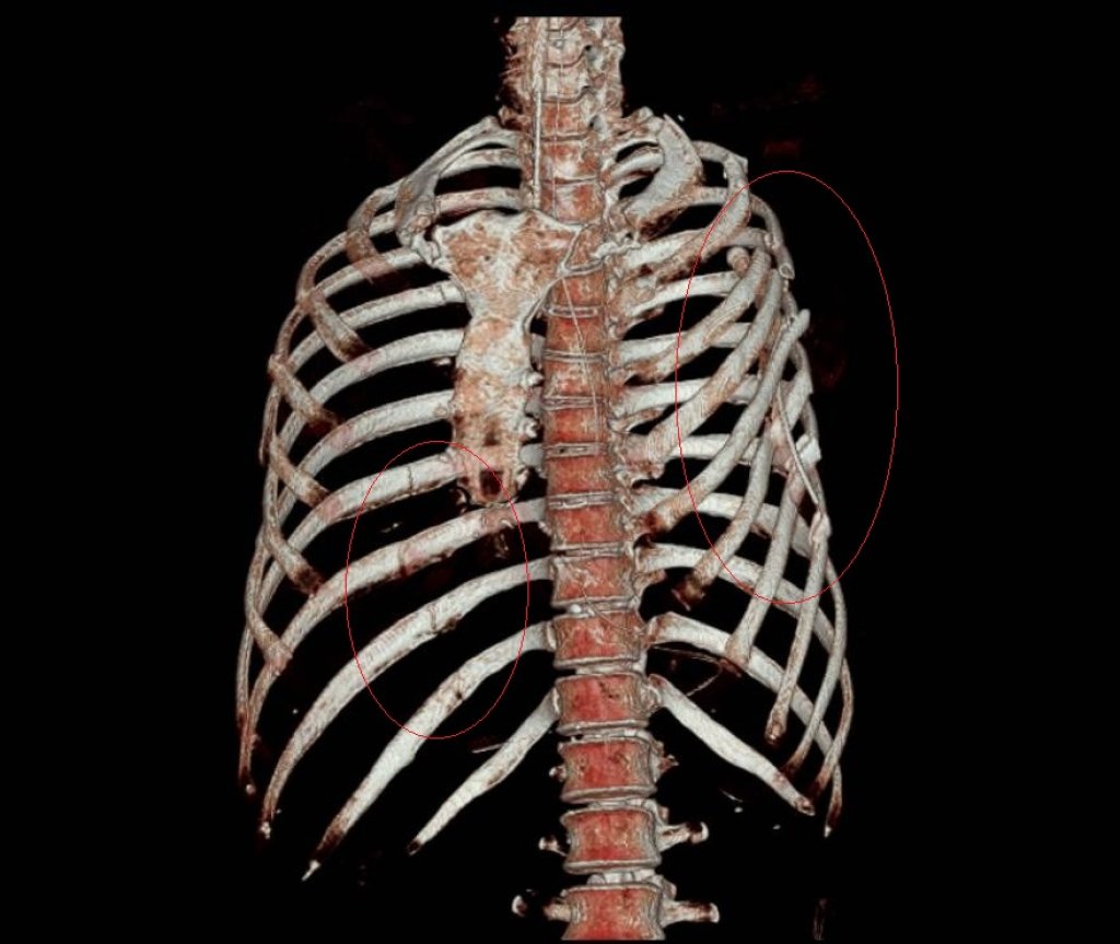 婦人車禍全身骨頭幾乎全斷 部彰醫院跨團隊救回一命 卻出現解離性失憶「斷片」