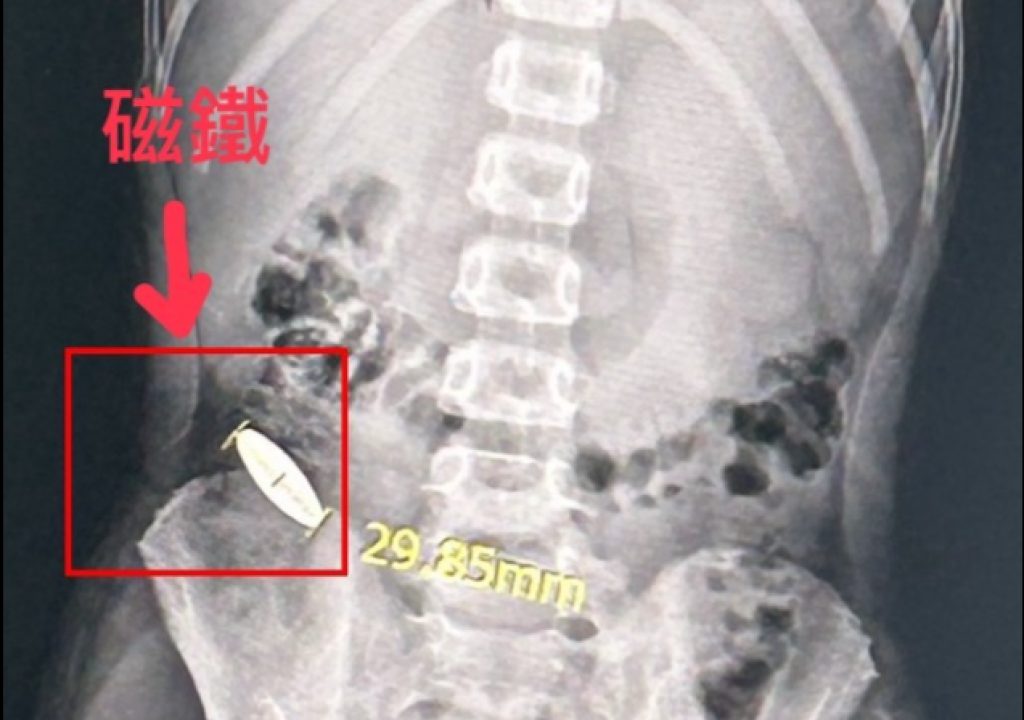 台南安南區某安親班傳霸凌！6歲童被11歲童逼吞3公分磁鐵　驚悚X光照片曝光