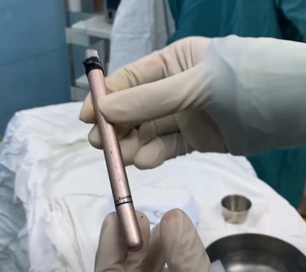 千萬別學！16歲少女下體癢「拿筆止癢」意外滑入體內　醫照超音波「卡在泌尿道」