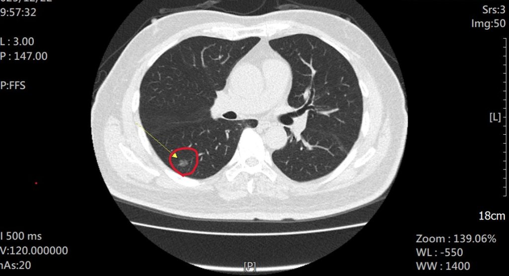 抽菸30多年男子為抱孫子戒菸 並接受LDCT檢查出1期肺癌 術後感謝孫子救了一命