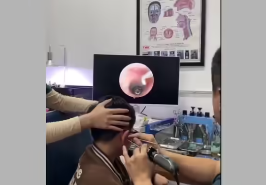 影／嚇壞醫師！童劇烈耳痛以為進水就醫　內視鏡一照「螺絲卡耳膜旁」