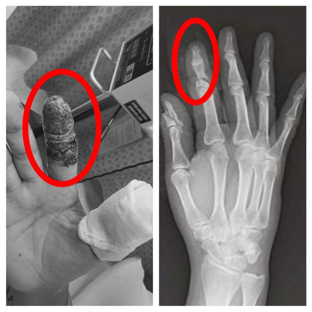 無人機削斷手指險截肢！　豐原醫院一個月「血流保衛戰」成功保住手指