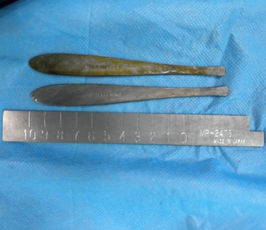 離奇！男腸道卡2把12公分湯匙　稱：吃新疆食品時不慎吞下