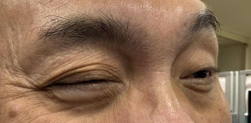 「右眼跳災!」嚇壞 60 歲男！部彰醫師：多半與自律神經失調有關