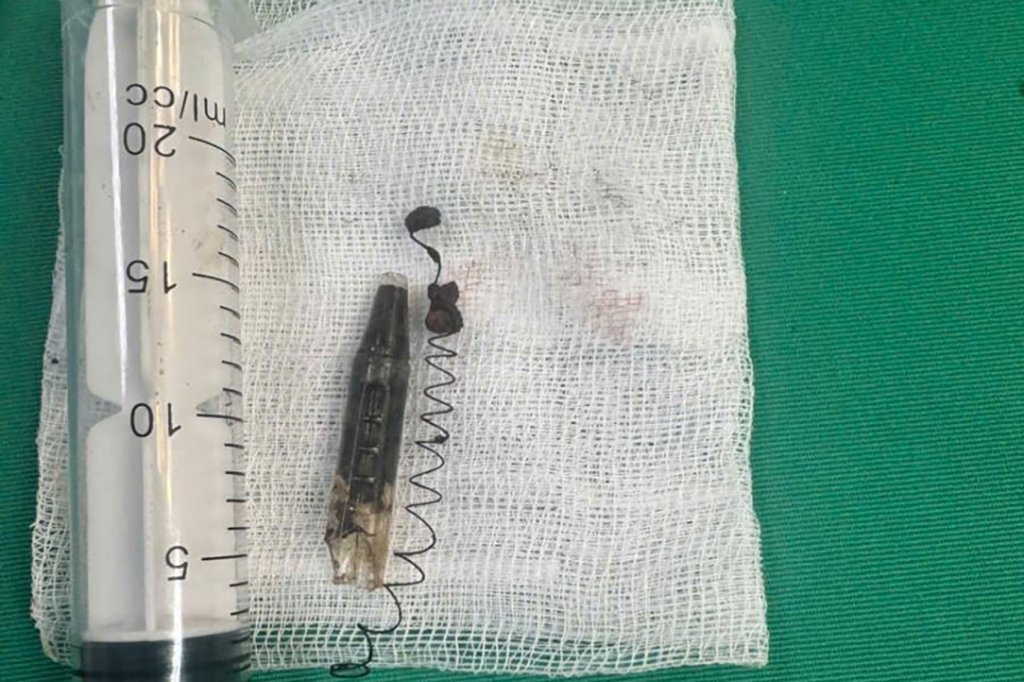 藏了13年未取出！越南男太陽穴驚見「原子筆頭與彈簧」　玩耍時被朋友刺中顳部