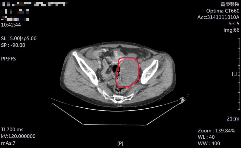 工地意外喊腿痛 竟是腸系膜大出血 2次手術救回一命