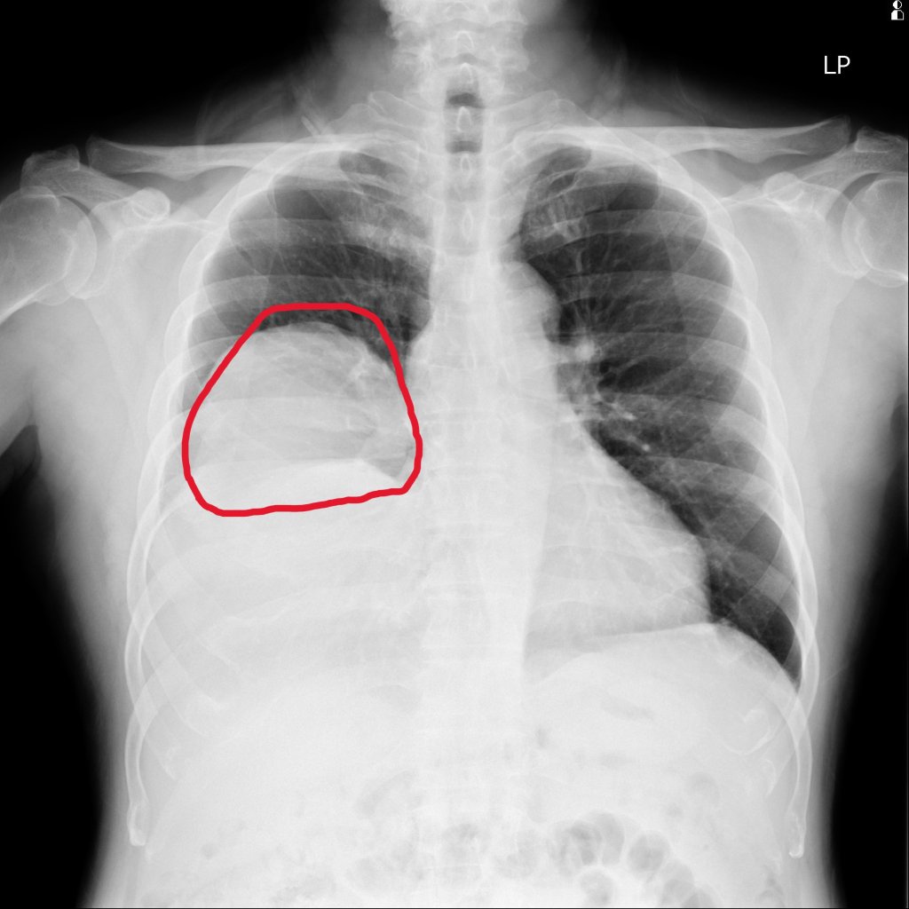 70歲翁低血糖反覆發作 竟非糖尿病而是25公分罕見肺腫瘤作祟