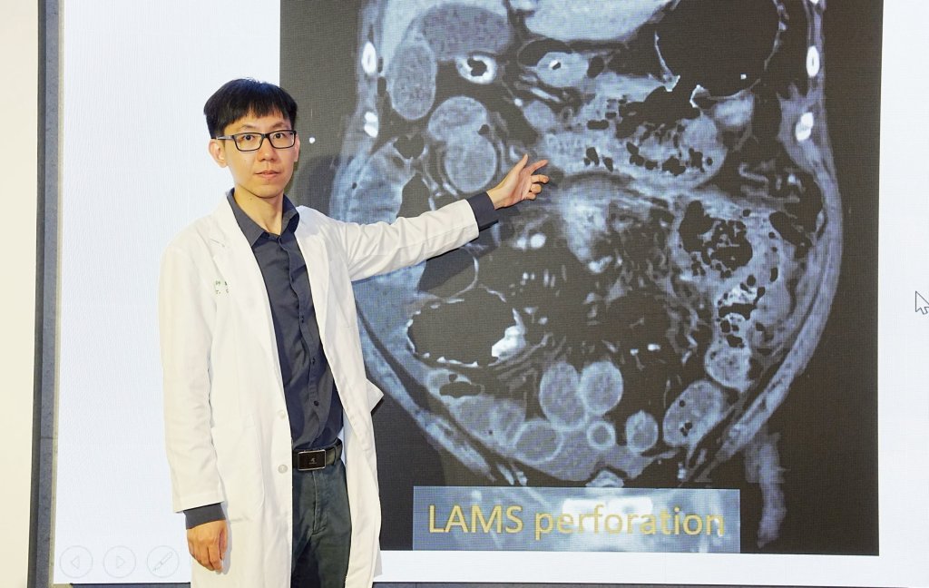 小小膽結石恐引發壞死性胰臟炎 中醫大附醫多專科團隊合力逆轉重症 大幅提升存活率