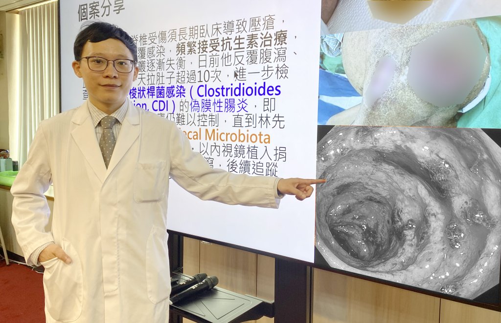 反覆腹瀉久治不癒 中榮用糞菌移植助患者重建腸道健康