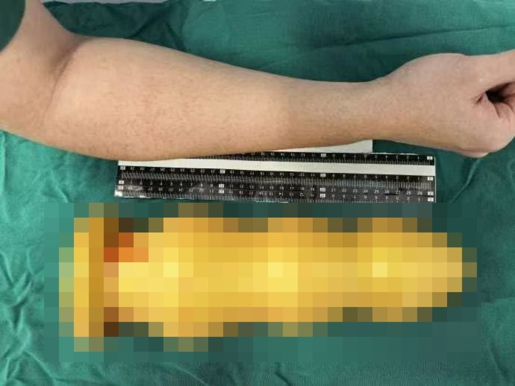 不小心？59歲男直腸塞進28公分異物頂到肺　醫師爆：上次是南瓜