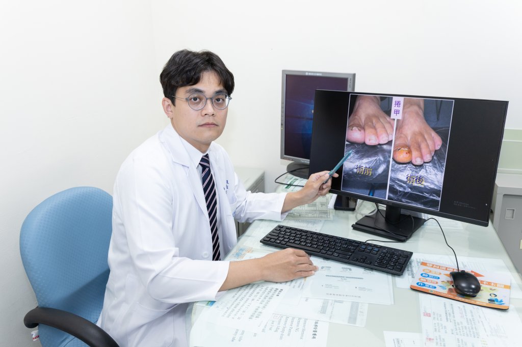 捲甲、嵌甲超擾人 甲床重建揮別腳趾疼痛