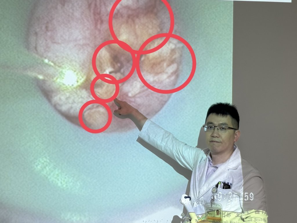 她的腎臟像長滿葡萄乾的雜糧麵包！  原來是「雷氏斑」作祟