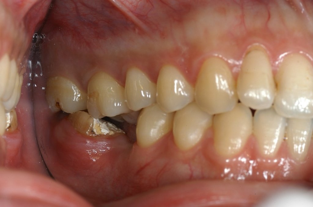 單顆植牙合併矯正及牙周補皮手術