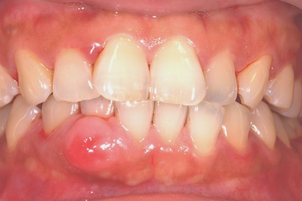 牙周膿腫