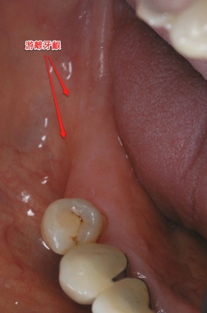 角化牙齦移植