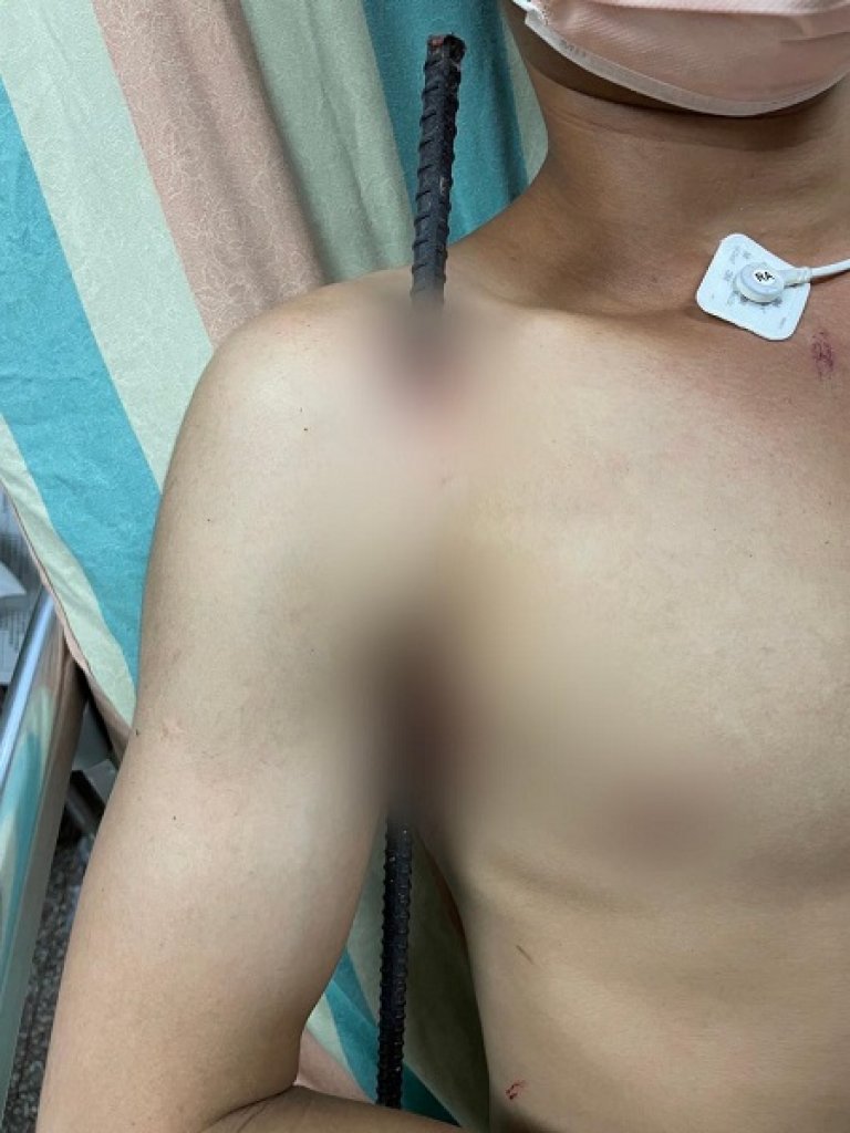 25歲男子遭鋼筋刺入右腋窩 醫師：現場不要拔除鋼筋