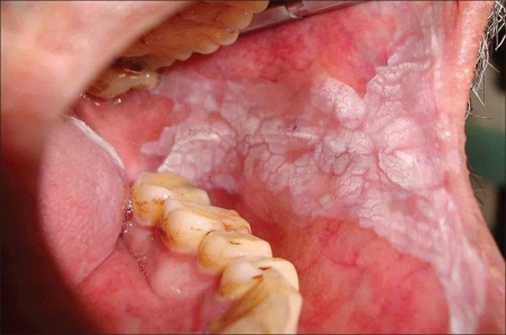 口腔白斑症 - 不可輕忽的癌前病變