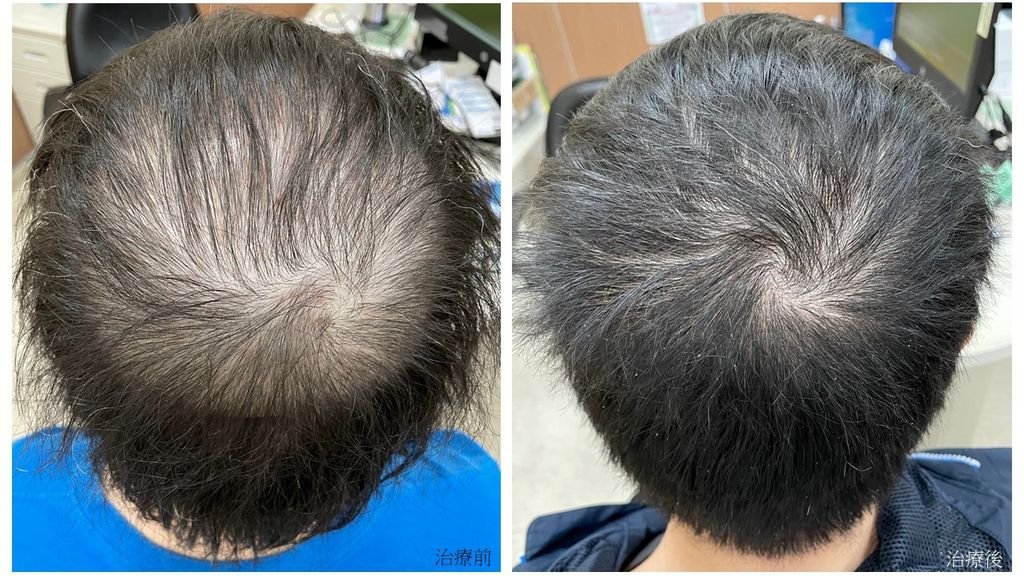 「雄性禿」搜尋量台南最高！多管齊下治療 改善掉髮問題