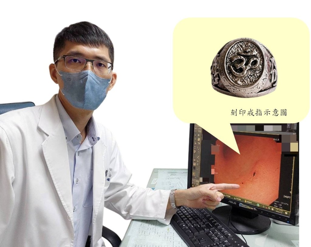 持續上腹悶痛  服藥沒改善   檢查竟是罕見胃癌