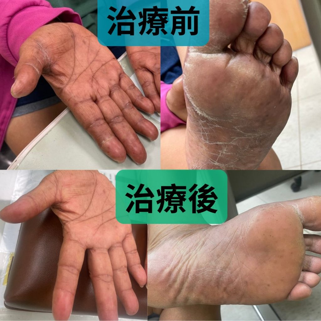 化療引發手足紅腫疼痛　 中醫調理助癌友擺脫不適