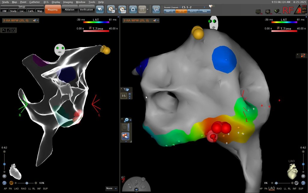 安南醫院成功完成首例兒童心律不整電燒手術 助小患者恢復正常心律